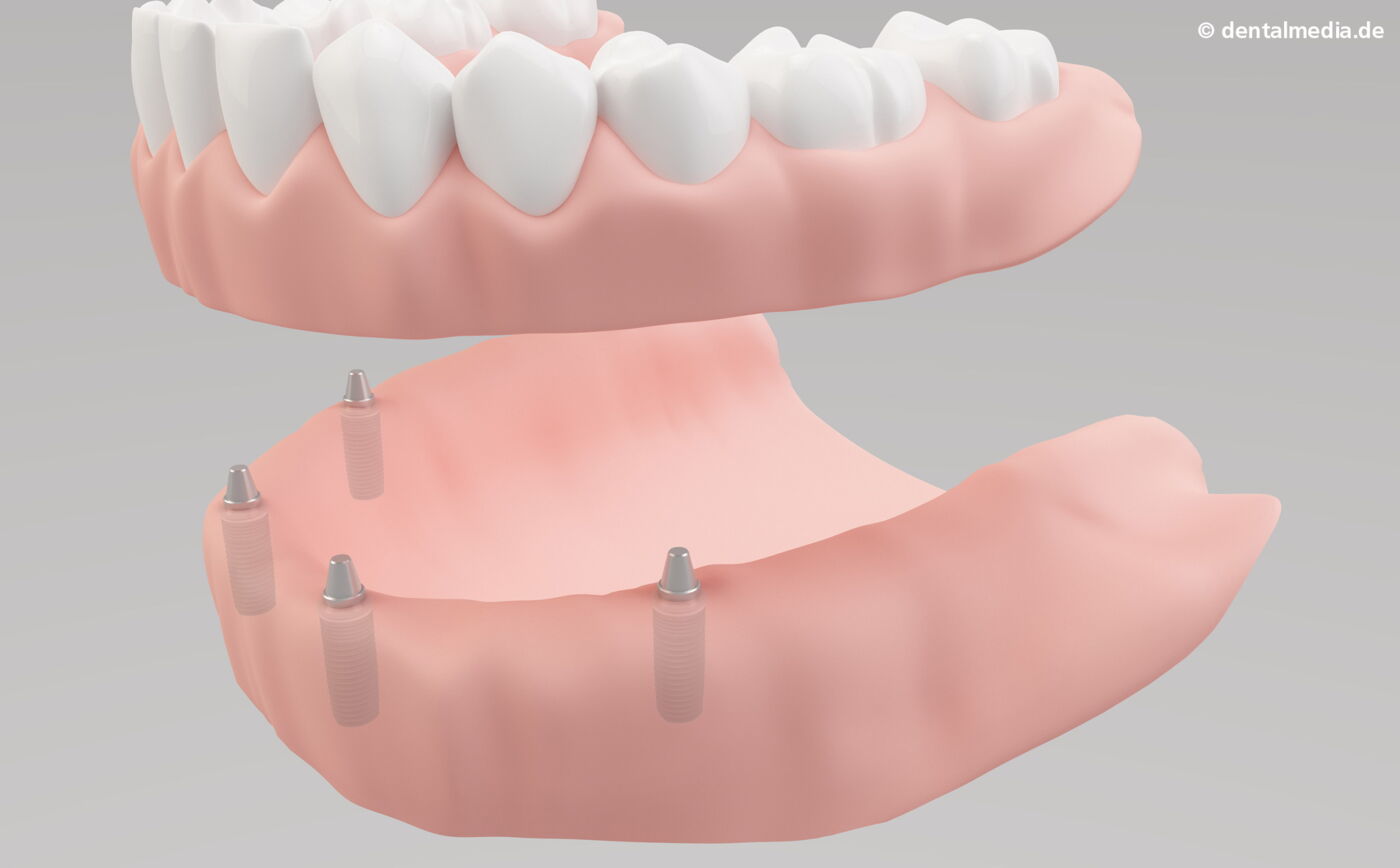 Sehr viele oder alle Zähne fehlen  Mit mehreren Implantaten haben Teil- oder Vollprothesen, herausnehmbar oder festsitzend, einen festen Halt.