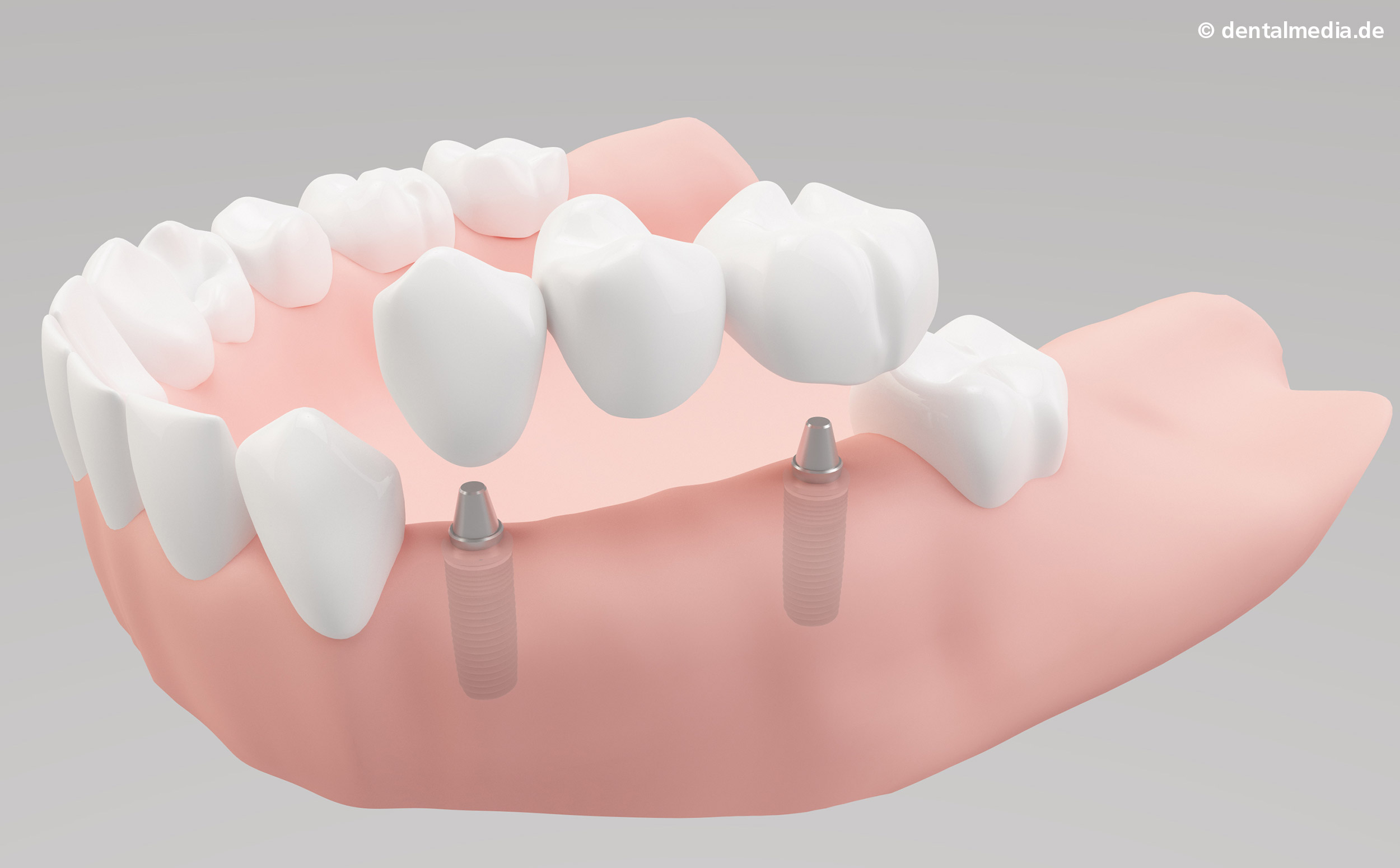Mehrere Zähne Ziehen Ohne Vollnarkose www.duesselsmile.de